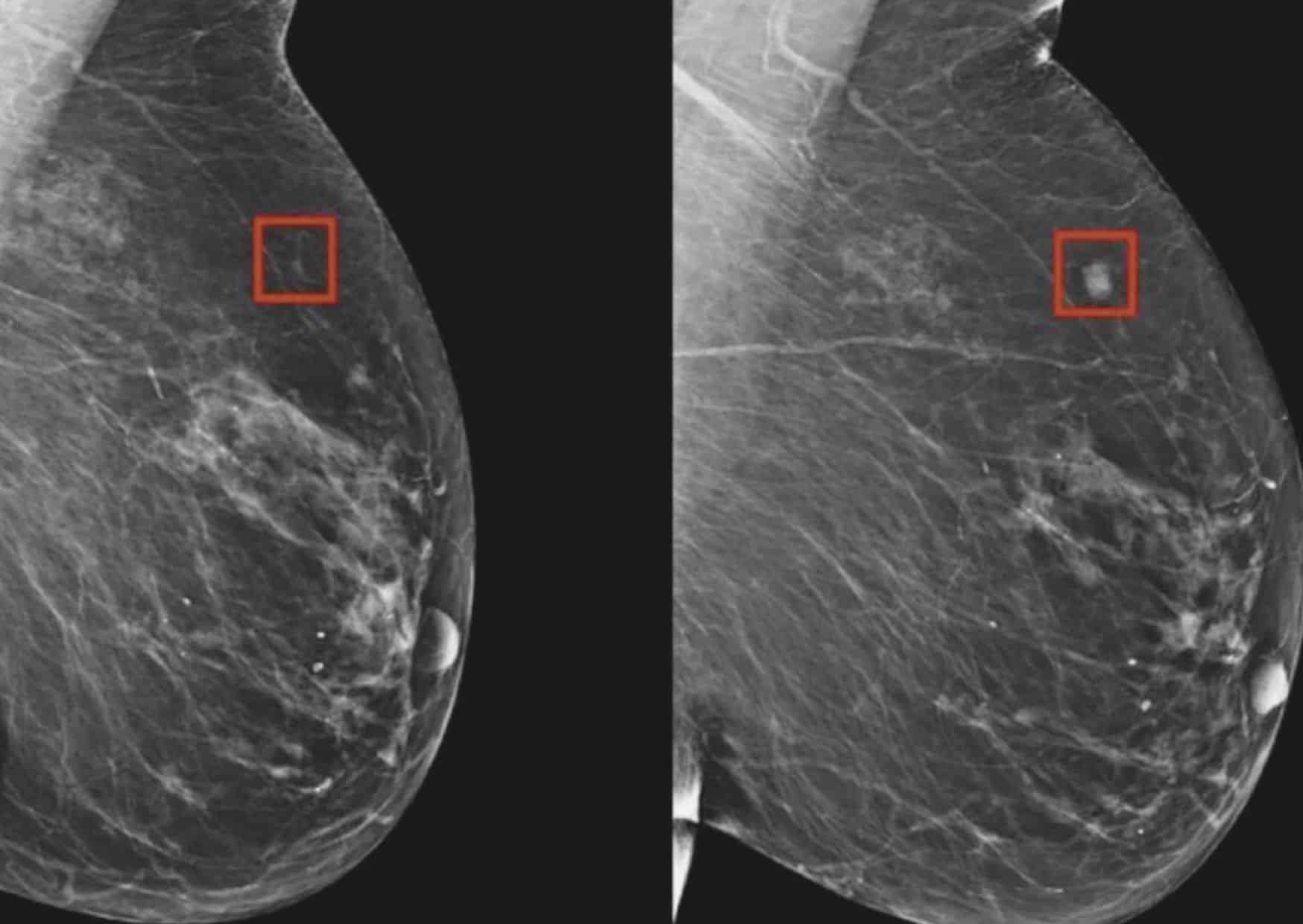 MIT Researchers Develop AI Model for Early Breast Cancer Detection